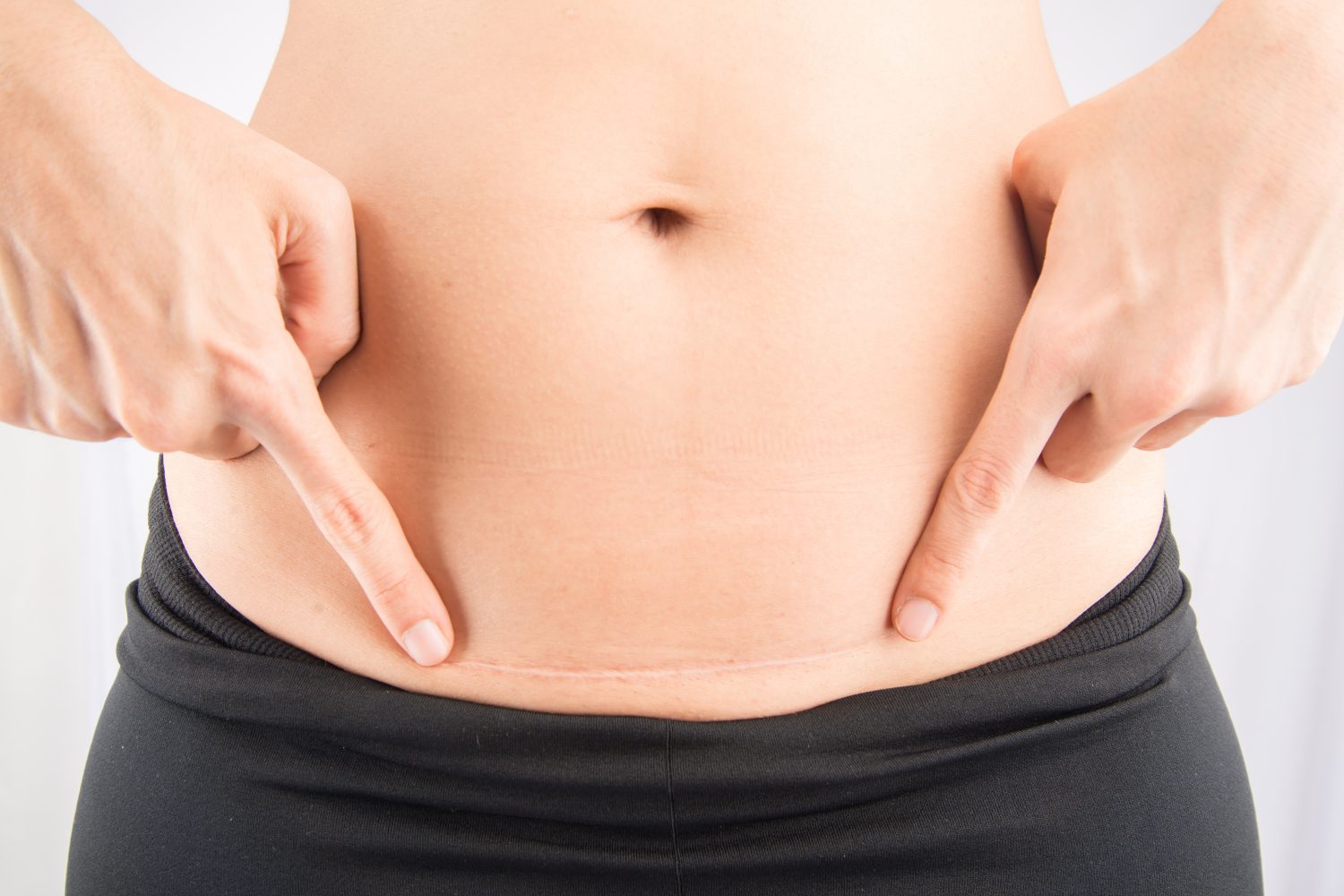 how to fade surgical scars